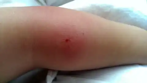 Mosquito Bite